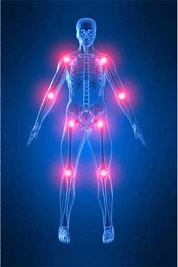 artritis
